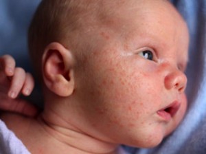 acne-neonatale
